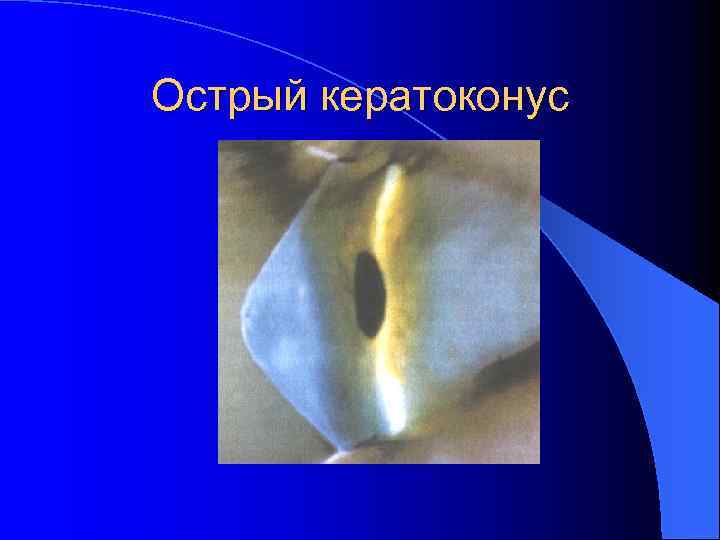 Острый кератоконус 