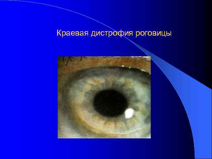 Краевая дистрофия роговицы 