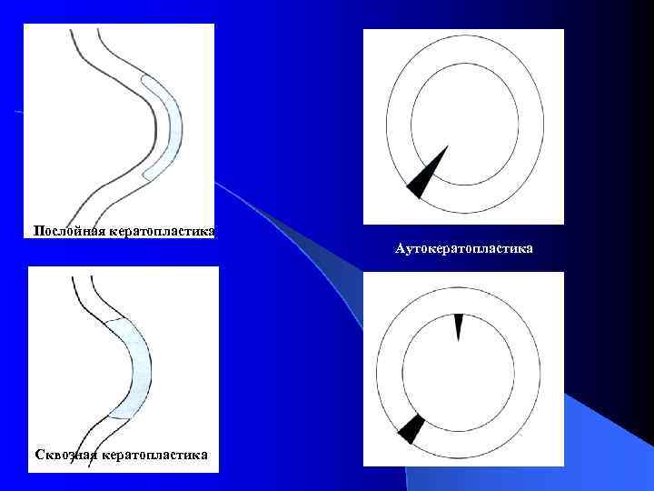 Послойная кератопластика Аутокератопластика Сквозная кератопластика 