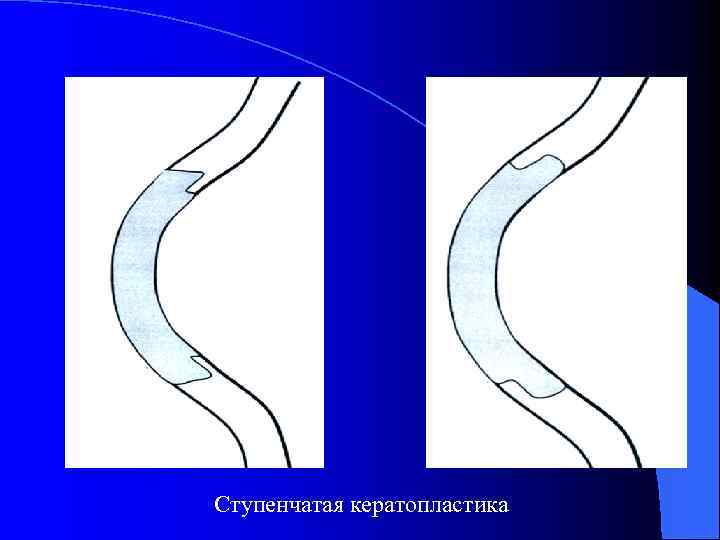 Ступенчатая кератопластика 