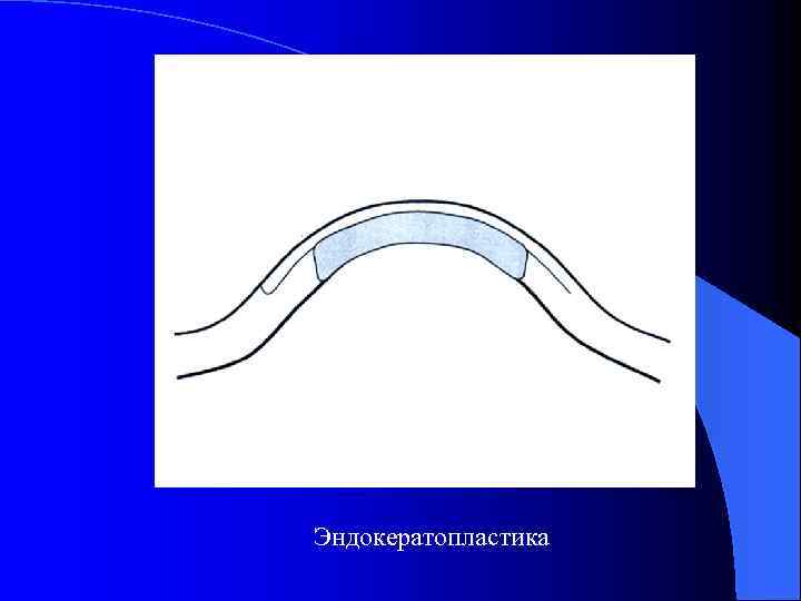 Эндокератопластика 
