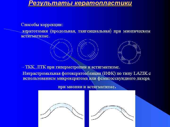 Кератопластика. Виды кератопластики. Кератопластика показания. Тангенциальная кератотомия. Виды кератопластики, показания.