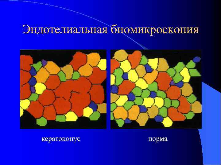 Эндотелиальная биомикроскопия кератоконус норма 