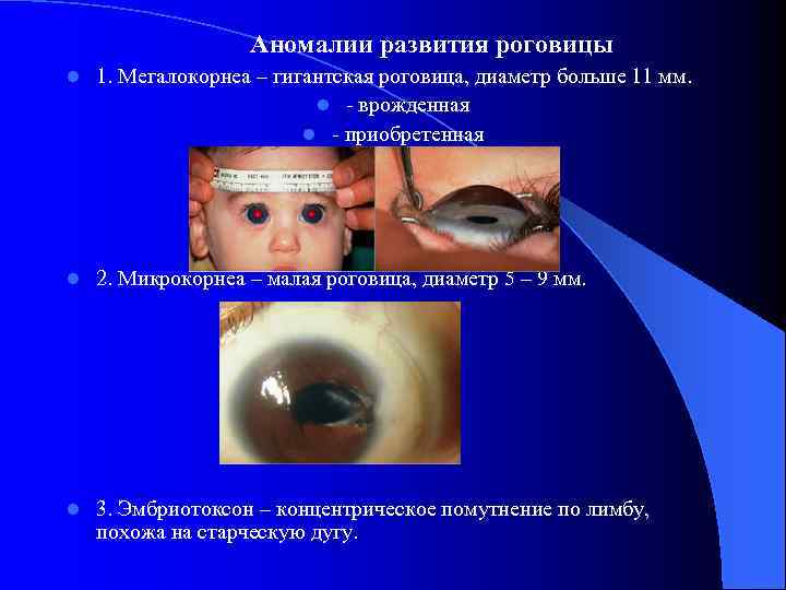 Аномалии развития роговицы l 1. Мегалокорнеа – гигантская роговица, диаметр больше 11 мм. l