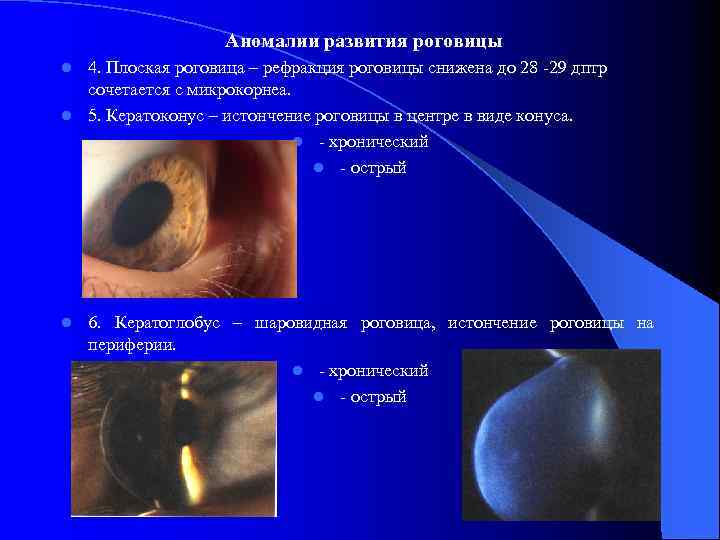 Аномалии развития роговицы 4. Плоская роговица – рефракция роговицы снижена до 28 -29 дптр