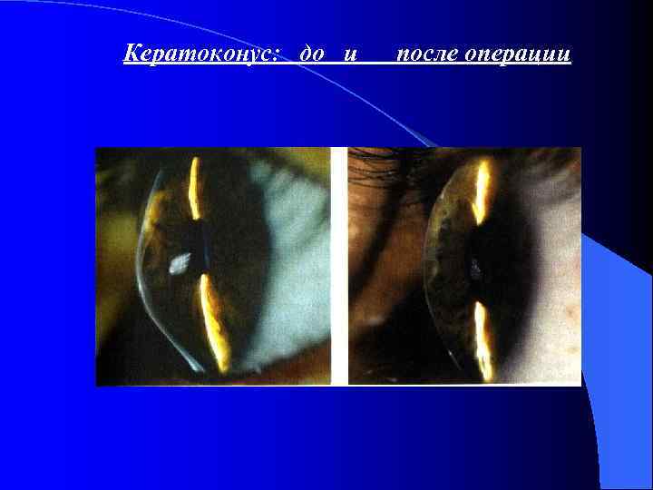  Кератоконус: до и после операции 