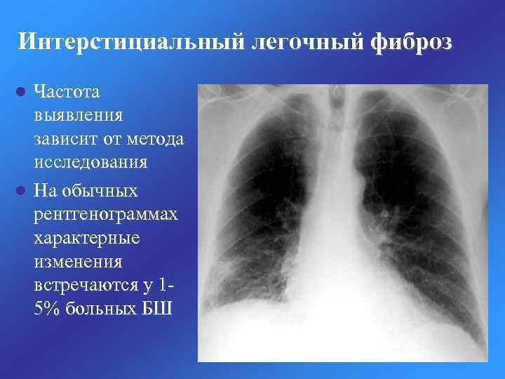 Что такое интерстициальный компонент легочного рисунка