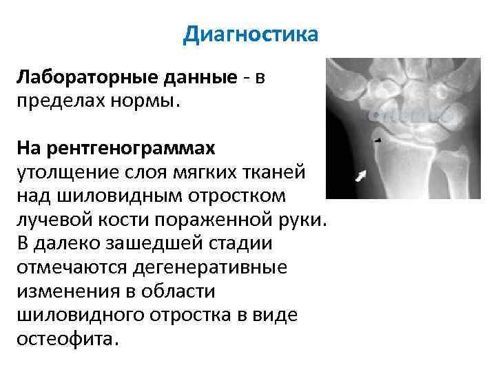 Диагностика Лабораторные данные - в пределах нормы. На рентгенограммах утолщение слоя мягких тканей над