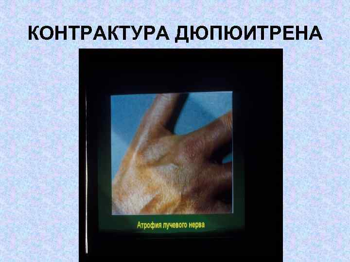 КОНТРАКТУРА ДЮПЮИТРЕНА 