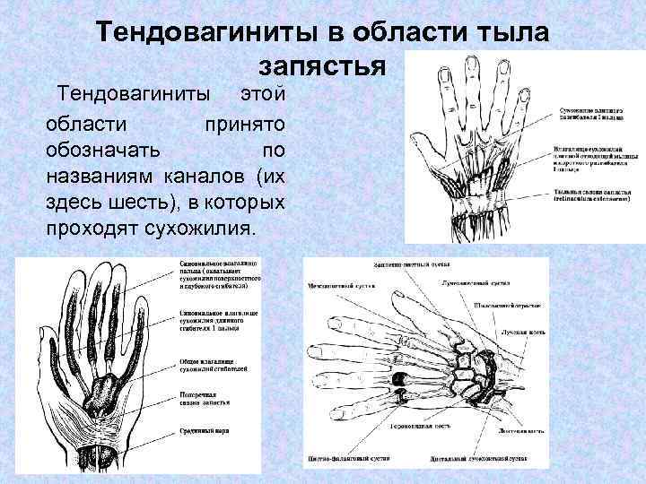 Тендовагиниты в области тыла запястья Тендовагиниты этой области принято обозначать по названиям каналов (их