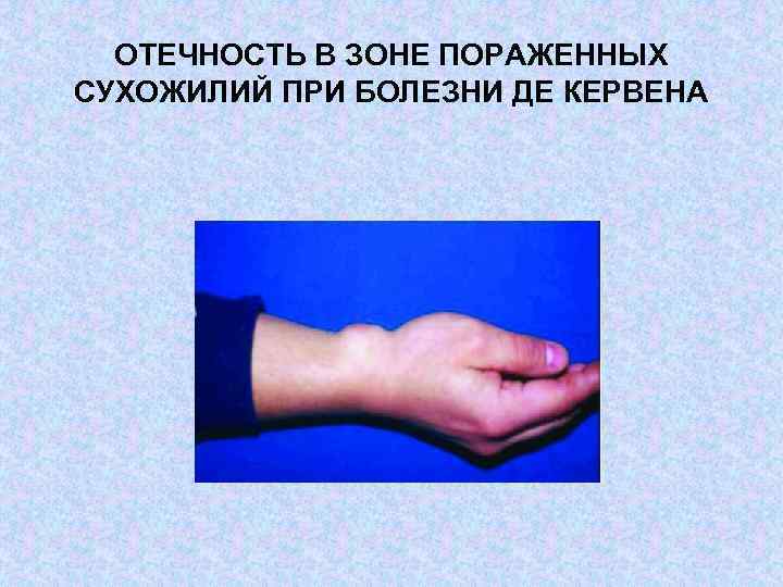 ОТЕЧНОСТЬ В ЗОНЕ ПОРАЖЕННЫХ СУХОЖИЛИЙ ПРИ БОЛЕЗНИ ДЕ КЕРВЕНА 