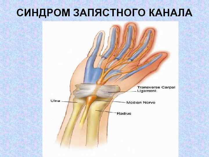 СИНДРОМ ЗАПЯСТНОГО КАНАЛА 