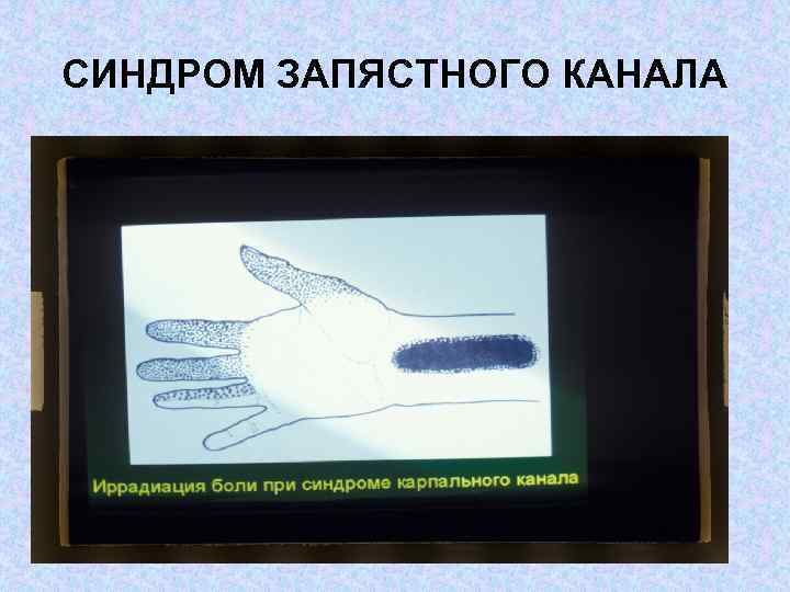 СИНДРОМ ЗАПЯСТНОГО КАНАЛА 