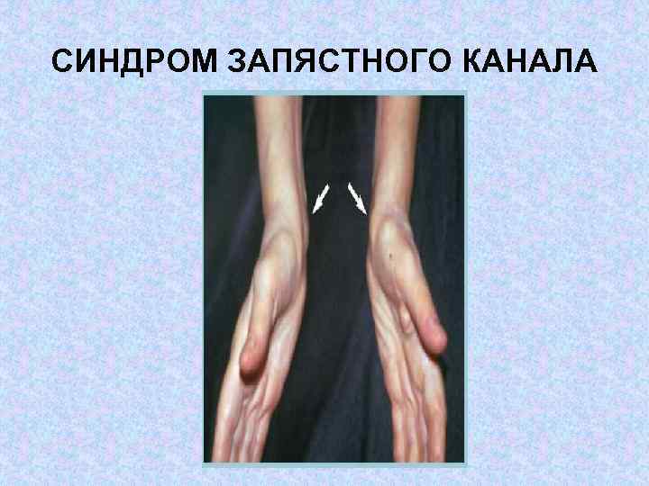 СИНДРОМ ЗАПЯСТНОГО КАНАЛА 