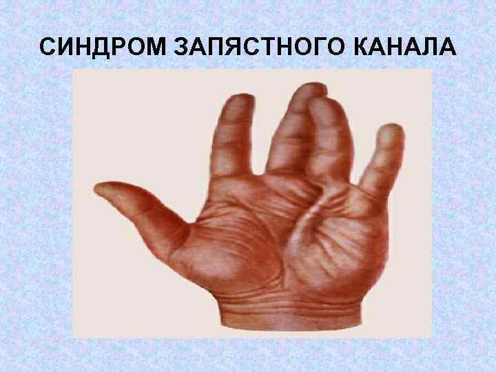 СИНДРОМ ЗАПЯСТНОГО КАНАЛА 