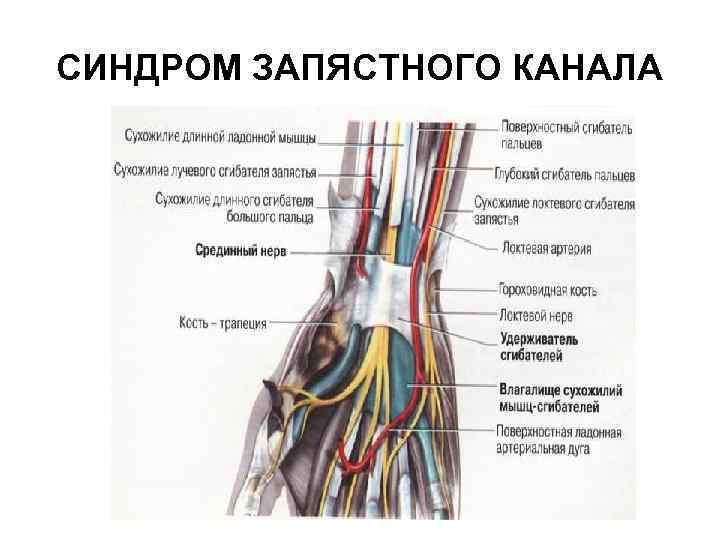 СИНДРОМ ЗАПЯСТНОГО КАНАЛА 