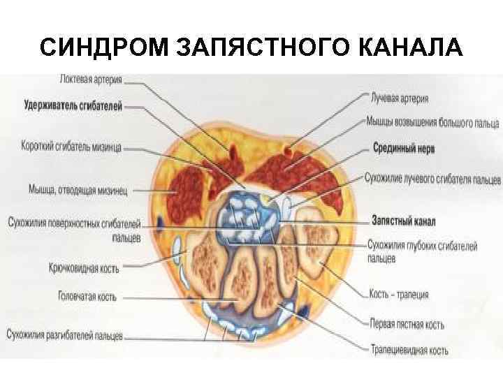 СИНДРОМ ЗАПЯСТНОГО КАНАЛА 