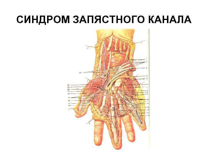 СИНДРОМ ЗАПЯСТНОГО КАНАЛА 