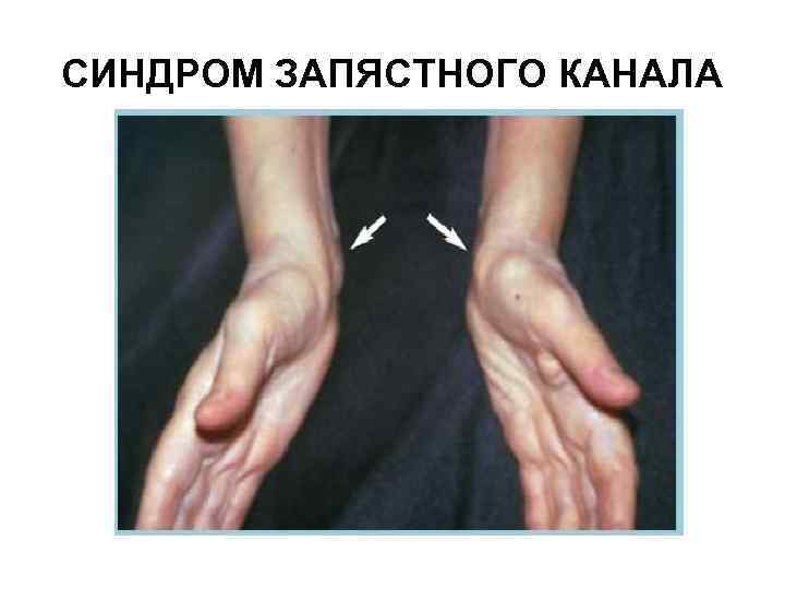 СИНДРОМ ЗАПЯСТНОГО КАНАЛА 