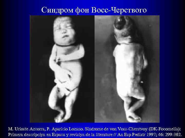Синдром фон Восс-Черствого M. Urioste Azcorra, P. Aparicio Lozano. Sindrome de von Voss-Cherstvoy (DK-Focomelia):