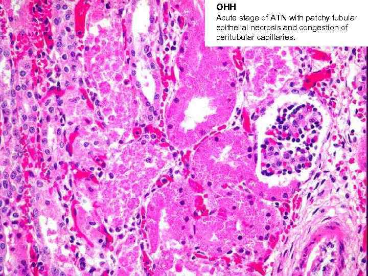 ОНН Acute stage of ATN with patchy tubular epithelial necrosis and congestion of peritubular