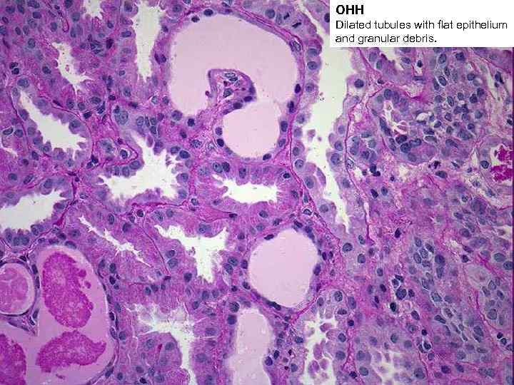 ОНН Dilated tubules with flat epithelium and granular debris. 