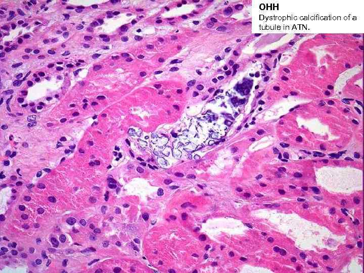 ОНН Dystrophic calcification of a tubule in ATN. 