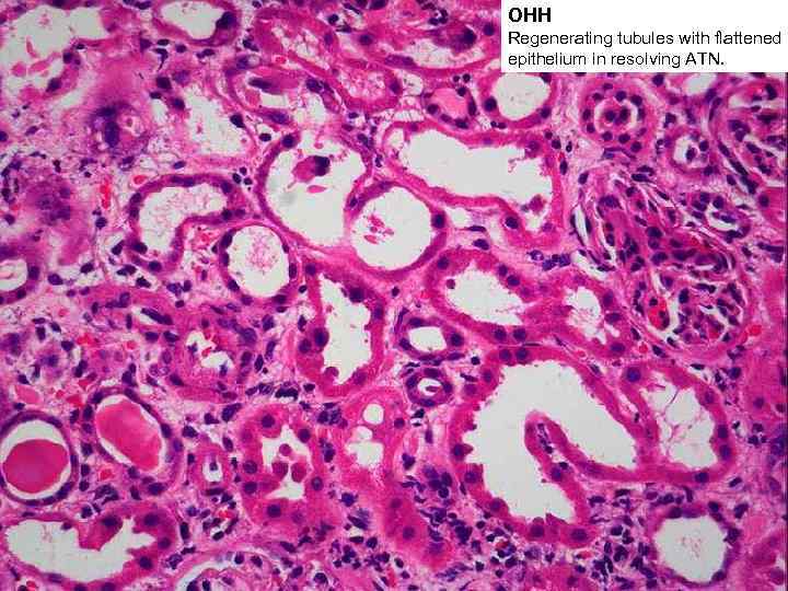ОНН Regenerating tubules with flattened epithelium in resolving ATN. 
