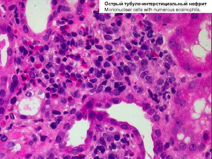 Острый тубуло-интерстициальный нефрит Mononuclear cells with numerous eosinophils. 