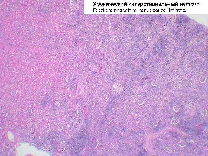 Хронический интерстициальный нефрит Focal scarring with mononuclear cell infiltrate. 