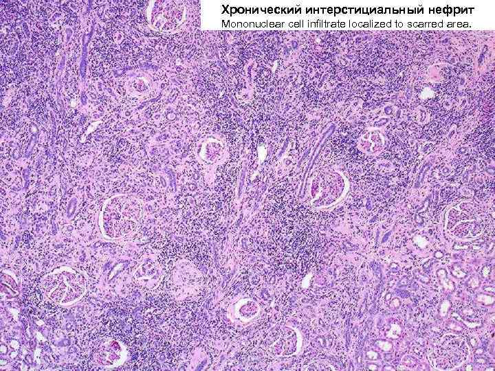 Хронический интерстициальный нефрит Mononuclear cell infiltrate localized to scarred area. 