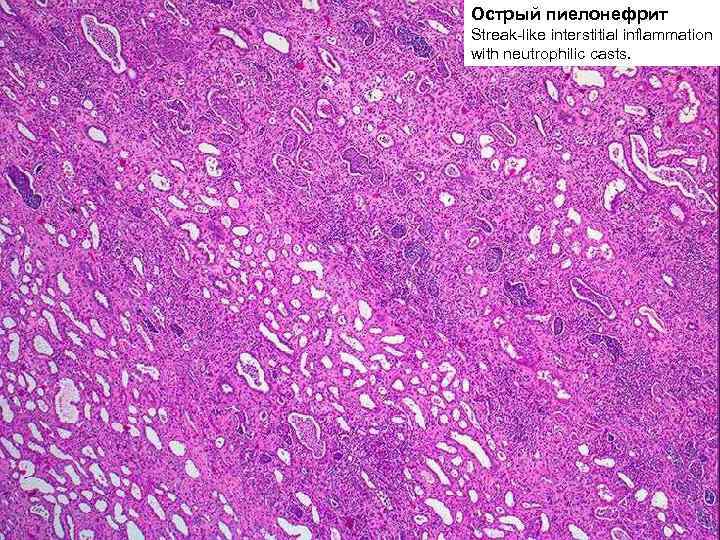 Острый пиелонефрит Streak-like interstitial inflammation with neutrophilic casts. 