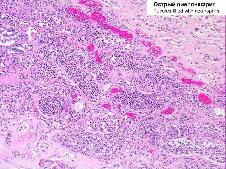 Острый пиелонефрит Tubules filled with neutrophils. 