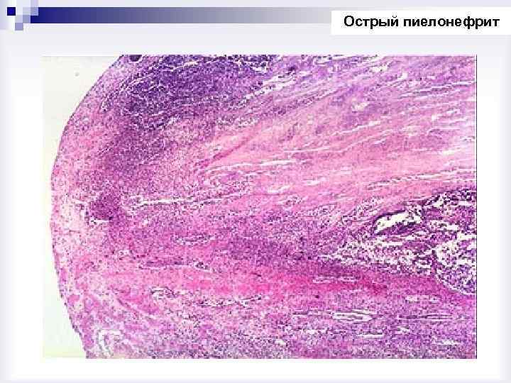 Острый пиелонефрит 