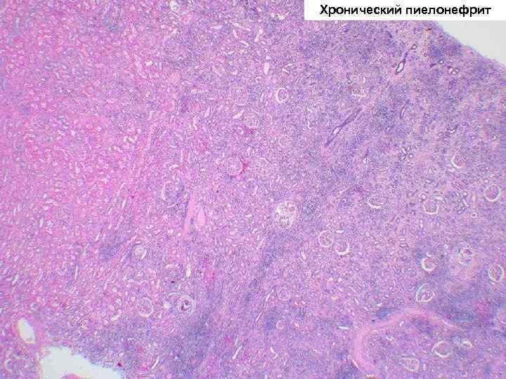 Хронический пиелонефрит 