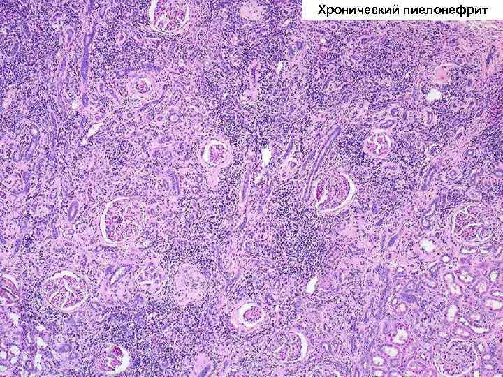 Хронический пиелонефрит 
