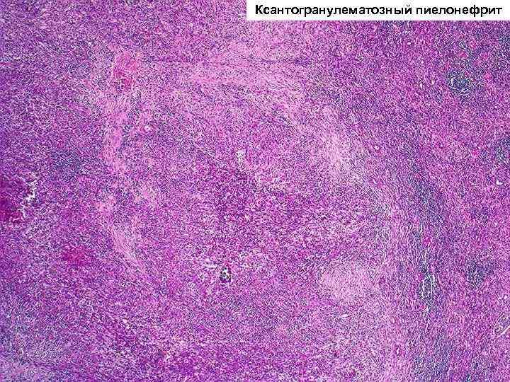 Ксантогранулематозный пиелонефрит 