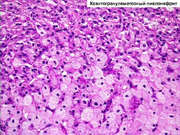 Ксантогранулематозный пиелонефрит 