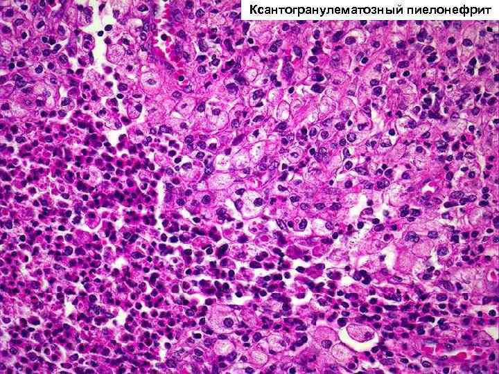 Ксантогранулематозный пиелонефрит 