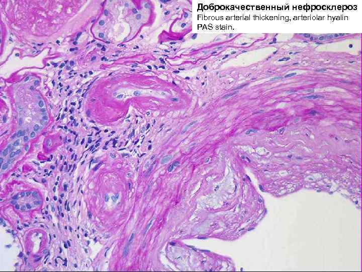 Артериолосклеротический нефросклероз микропрепарат рисунок