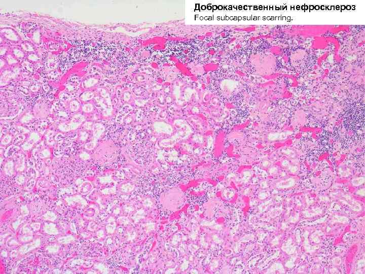 Артериолосклеротический нефросклероз микропрепарат рисунок