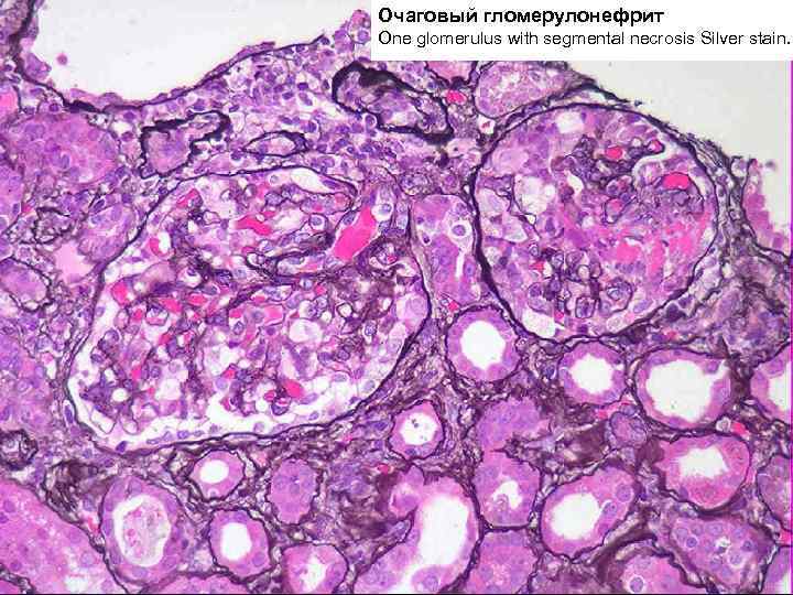 Очаговый гломерулонефрит One glomerulus with segmental necrosis Silver stain. 