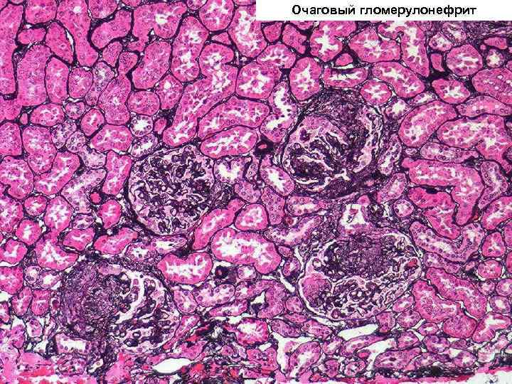 Очаговый гломерулонефрит 