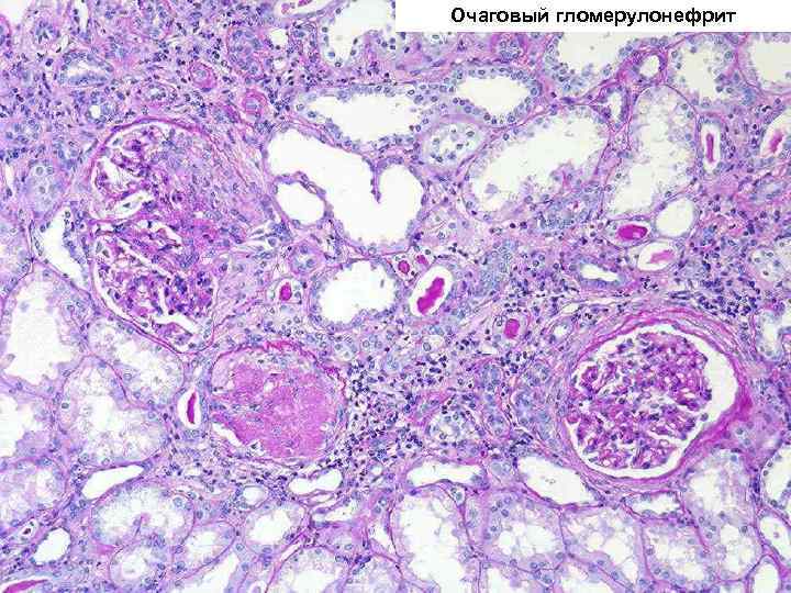 Очаговый гломерулонефрит 