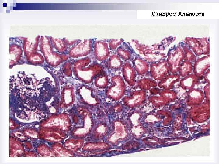 Синдром Альпорта 