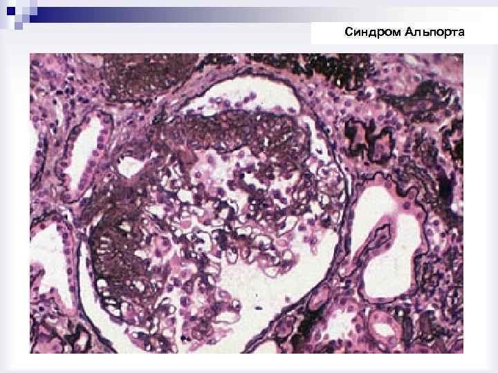 Синдром Альпорта 