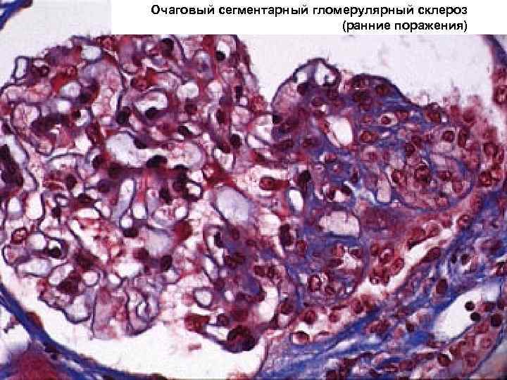 Очаговый сегментарный гломерулярный склероз (ранние поражения) 