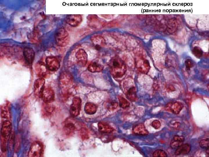 Очаговый сегментарный гломерулярный склероз (ранние поражения) 