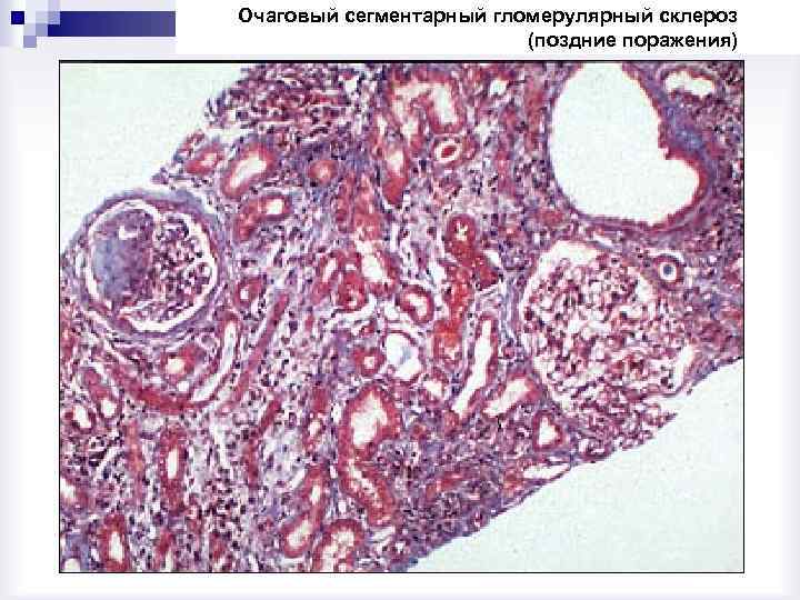 Очаговый сегментарный гломерулярный склероз (поздние поражения) 