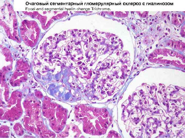 Склероз молочной железы. Очаговый сегментарный гломерулосклероз. Фокальный сегментарный гломерулосклероз патанатомия. Диабетический гломерулосклероз патанатомия. Фокальный сегментарный гломерулосклероз (гиалиноз).
